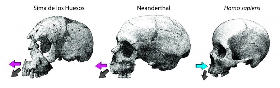 Growth directions of the maxilla in the Sima de los Huesos (SH) and Neanderthals compared to modern humans. This impacts facial growth in at least two ways. (i) Extensive bone deposits over the maxilla in the fossils are consistent with a strong forward growth component (purple arrows); whereas resorption in the modern human face attenuates forward displacement (blue arrow). (ii) Deposition combined with larger developing nasal cavities in the fossils displaces the dentition forward generating the retromolar space characteristic of Neanderthals and also in some SH fossils. 