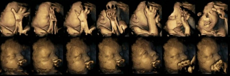 Yukarıdaki görüntü grubu sigara kullanan annenin rahmindeki fetusu gösteriyor. Aşağıdaki görüntü grubu ise hamilelik sırasında sigara kullanmayan annenin rahmindeki fetusun görüntüsü.